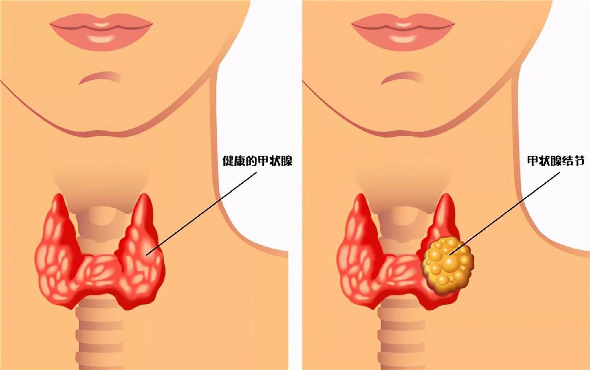 甲状腺炎怎么治疗 自身免疫性甲状腺炎怎么治疗